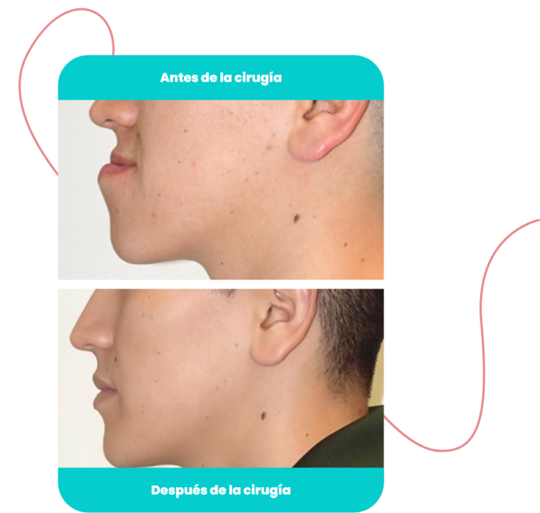 Antes y después de la cirugía maxilofacial